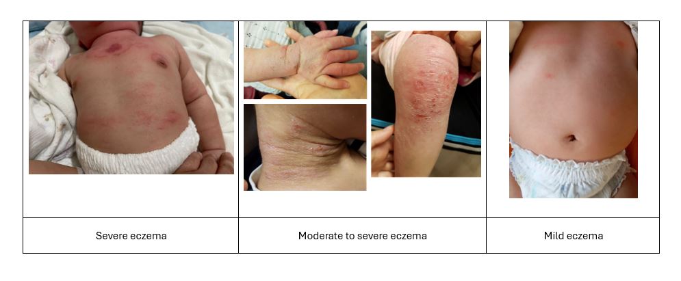 Different severity level of eczema